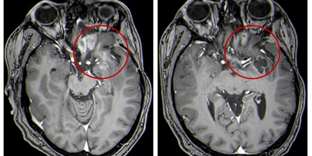 This combination of MRI images provided by the University of Alabama in April 2021 shows scans of a child with a brain tumor, before and after a treatment that involves using viruses to spur an immune system response to the cancerous cells. Lighter-colored areas inside the red circles indicate the tumor size.