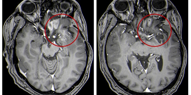 This combination of MRI images provided by the University of Alabama in April 2021 shows scans of a child with a brain tumor, before and after a treatment that involves the use of viruses to stimulate an immune system response to cancer cells. . The lighter colored areas within the red circles indicate the size of the tumor.
