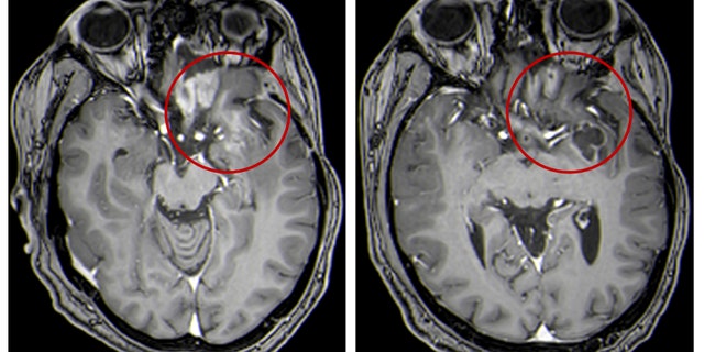 Esta combinación de imágenes de resonancia magnética proporcionadas por la Universidad de Alabama en abril de 2021 muestra exploraciones de un niño con un tumor cerebral, antes y después del tratamiento que implica el uso de virus para estimular la respuesta del sistema inmunológico a las células cancerosas.  Las áreas de color claro dentro de los círculos rojos indican el tamaño del tumor.