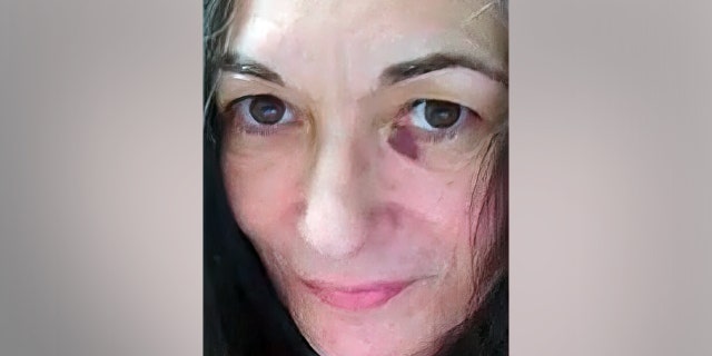 Image shows Ghislaine Maxwell's black eye as of April 29, 2021 (court documents)