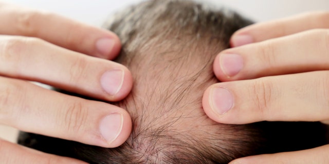 Why can chronic stress result in hair loss? New research provides clues | Fox News Why can chronic stress result in hair loss? New research provides clues | Fox News