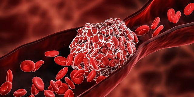 Blood consists of red blood cells, white blood cells and platelets that float in the liquid portion of the blood known as plasma, according to Cleveland Clinic. When we bleed, this initiates the coagulation — or clotting cascade — that activates proteins on platelets to clump to fill the hole in the blood vessel so that we stop bleeding, one doctor explained. 