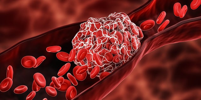 According to the Cleveland Clinic, blood is made up of red blood cells, white blood cells, and platelets that float in the liquid part of the blood known as plasma.  When we bleed, this initiates coagulation — or a clotting cascade — that activates platelet proteins that stick together to fill the hole in the blood vessel so we stop the bleeding, one doctor explained. 