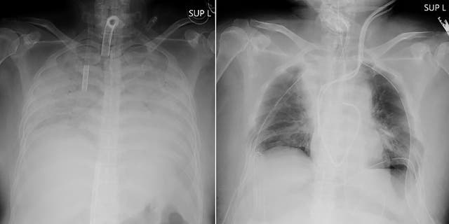 April 9, 2021: This combination of radiographs provided on April 9, 2021, by Kyoto University Hospital, shows the chest of a patient before the surgery, left, and after the surgery, right. 