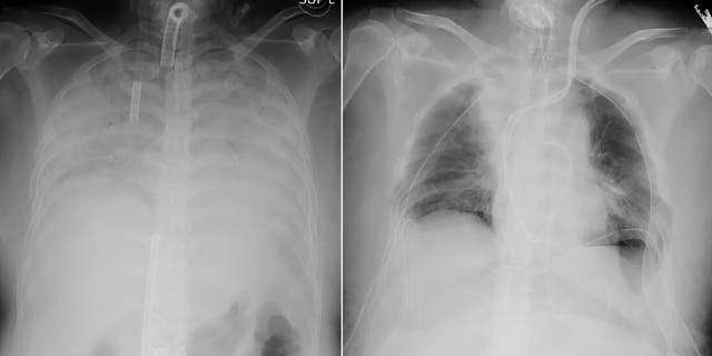 April 9, 2021: This combination of radiographs provided on April 9, 2021, by Kyoto University Hospital, shows the chest of a patient before the surgery, left, and after the surgery, right. 