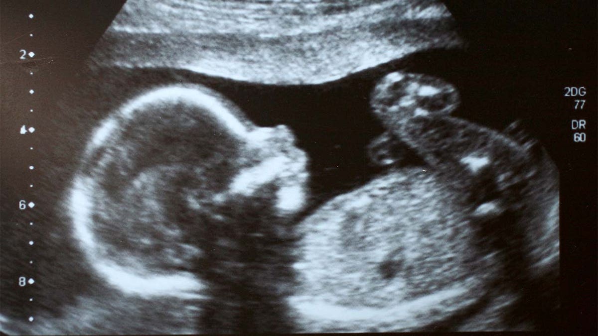 Fetus in ultrasound