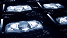 FDA approves new prostate cancer imaging tool, company says