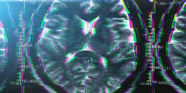 Brain scan picture