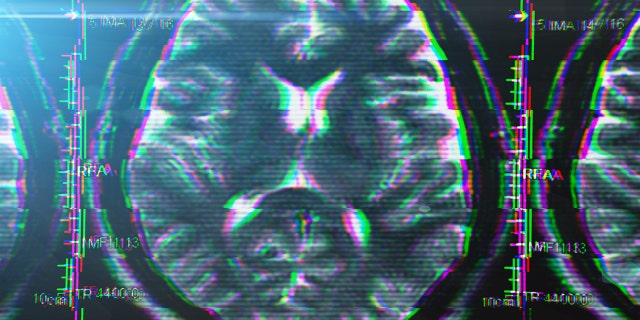 Un expert care nu este implicat în studiu a declarat pentru Fox News Digital că a fost încântată să vadă diferența semnificativă statistic între grupurile de lecanemab și placebo din studiu, dar a avertizat că sunt necesare mai multe cercetări asupra medicamentului Alzheimer.