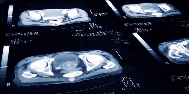 Diapositivas de rayos X de un paciente con cáncer de próstata