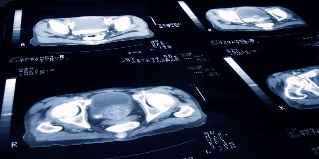 FILE - X-Ray Slides of a Patient with Prostate Cancer