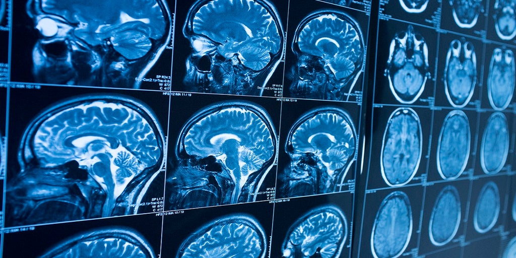 Teenage brains aged faster during the pandemic from stress, anxiety: study - Vimarsana News