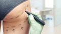 plastic surgeon marking womans body for plastic surgery