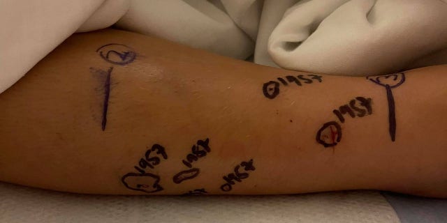 It took more than 41 doses of anti-venom to bring the swelling down in Maisy's leg.