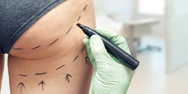 The Brazilian butt lift is one of the deadliest — and fastest-growing — plastic surgeries.