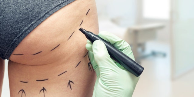 The BBL is a fat-grafting process in which fat is removed from other areas via liposuction — and injected into the buttocks.