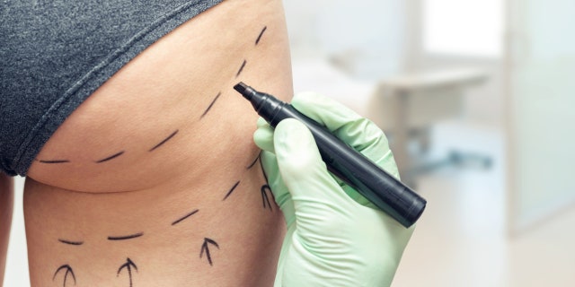 The BBL is a fat-grafting process in which fat is removed from other areas via liposuction — and injected into the buttocks. 