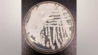 'Superbug' fungus spread in two cities, health officials say