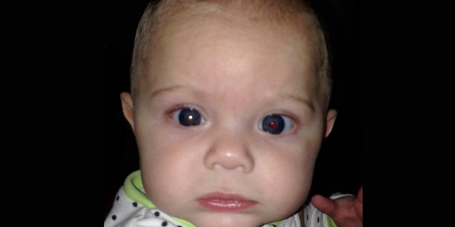 Asher's right eye glowed white, alerting his mother to see a doctor for her son, who was 3 months old at the time. 