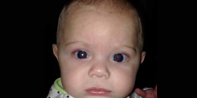 Asher's right eye had a white glow to it, alerting his mother to seek medical attention for her son, who was 3-months old at the time.