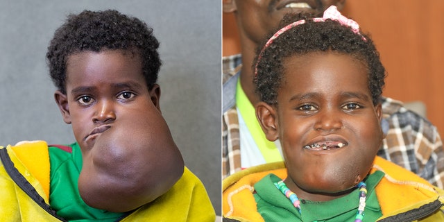 Nagalem, pictured left before her surgery and right at a press conference held after, was in danger of suffocating or starving due to the growth. 