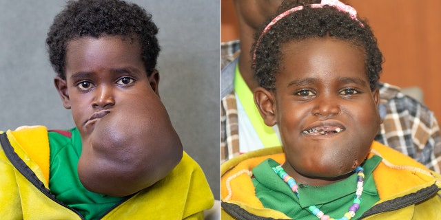 Nagalem, pictured left before her surgery and right at a press conference held after, was in danger of suffocating or starving due to the growth. 