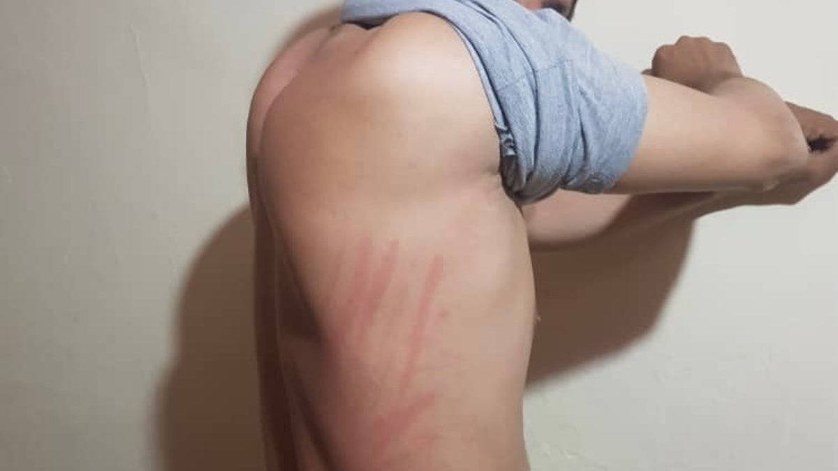 The beatings left marks on the interpreter's back and legs.