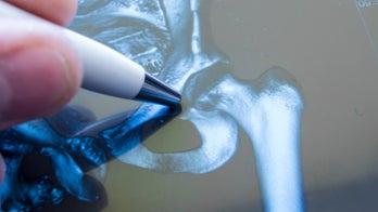 Osteoporotic fractures pose serious harm to men, too: study