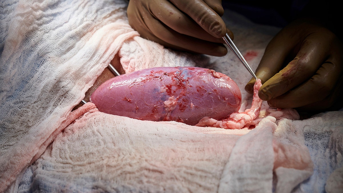 In this September 2021 photo provided by NYU Langone Health, a surgical team at the hospital in New York examines a pig kidney attached to the body of a deceased recipient for any signs of rejection. The test was a step in the decades-long quest to one day use animal organs for life-saving transplants. (Joe Carrotta/NYU Langone Health via AP)