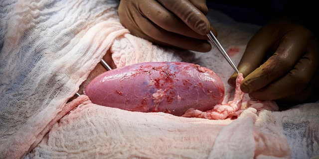 In this September 2021 photo provided by NYU Langone Health, a surgical team at the hospital in New York examines a pig kidney attached to the body of a deceased recipient for any signs of rejection. The test was a step in the decades-long quest to one day use animal organs for life-saving transplants. (Joe Carrotta/NYU Langone Health via AP)