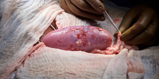 In this September 2021 photo provided by NYU Langone Health, a surgical team at the hospital in New York examines a pig kidney attached to the body of a deceased recipient for any signs of rejection. The test was a step in the decades-long quest to one day use animal organs for life-saving transplants. (Joe Carrotta/NYU Langone Health via AP)