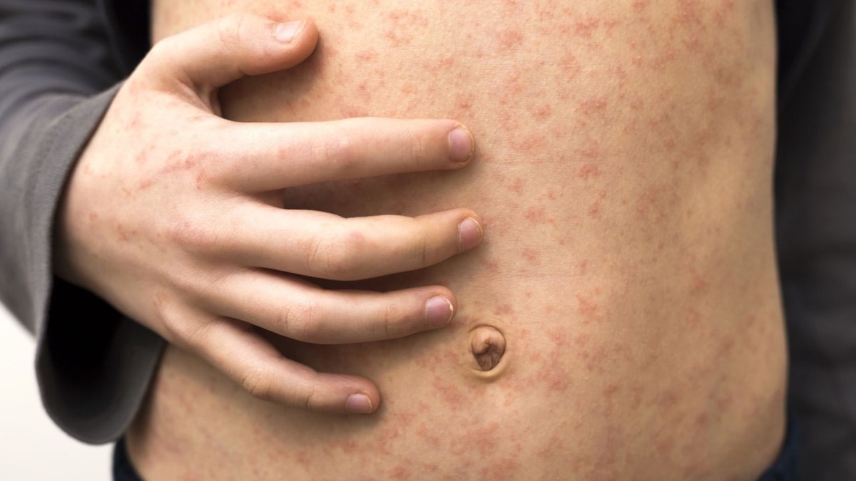 measles outbreak on the skin