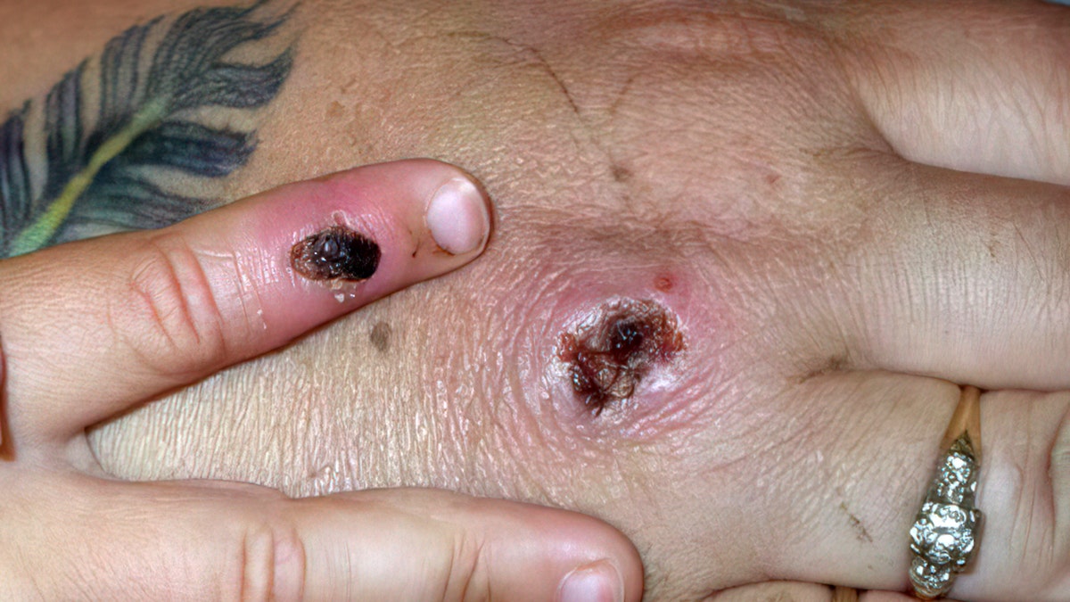 Monkeypox shown on patient's hand