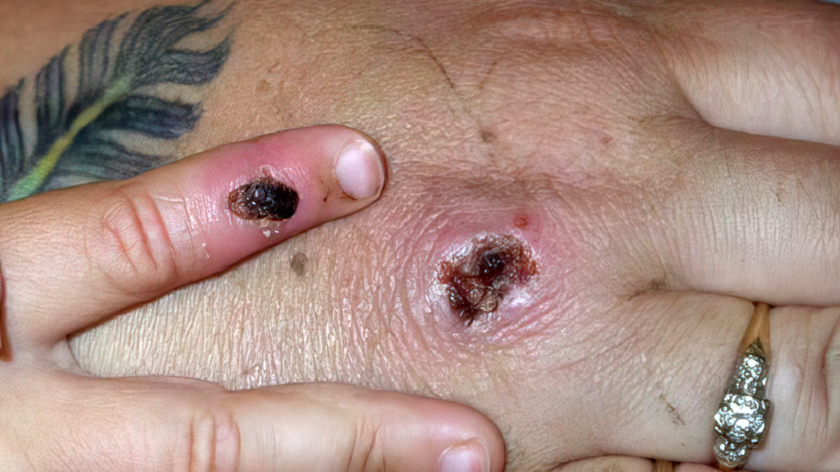 Monkeypox virus