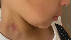 Texas mom irate, finds hickeys on bullied 6-year-old daughter's neck after school: 'Sexual assault'