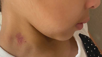 Texas mom irate, finds hickeys on bullied 6-year-old daughter's neck after school: 'Sexual assault'