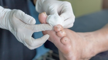 Diabetic foot ulcer treatment could kill COVID-19 virus, researchers say