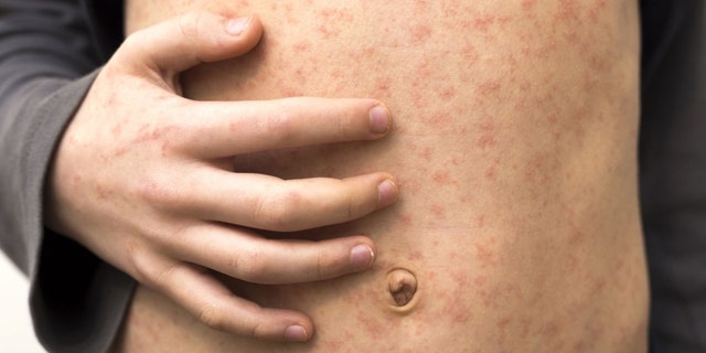 A patient inflicted with measles.