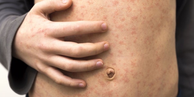 A patient with measles.