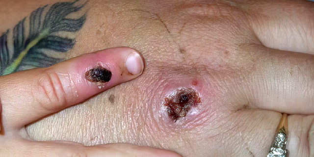 In this graphic from the Centers for Disease Control and Prevention, symptoms of one of the earliest known cases of monkeypox virus are shown on a patient's hand.