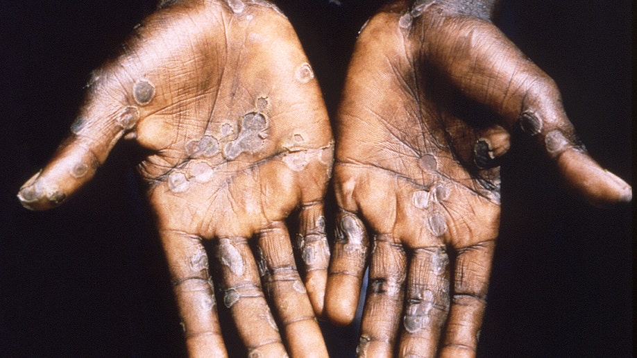 Monkeypox case