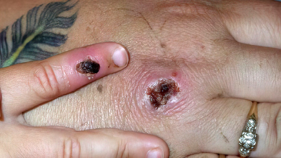 Monkeypox virus lesions on a patient's hands