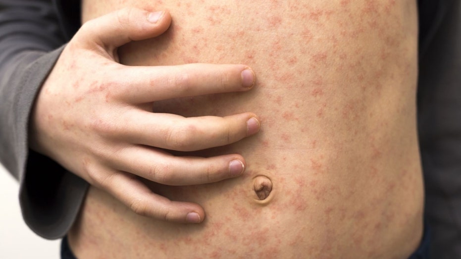 Georgia health officials link third measles case to unvaccinated international traveler