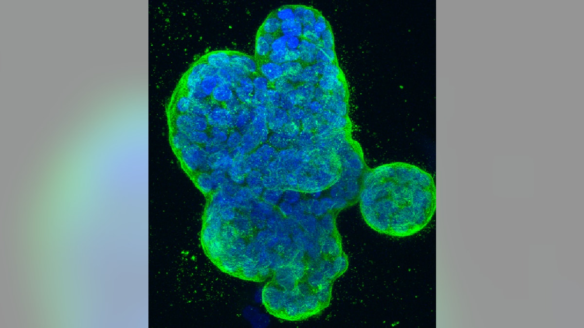 This photo provided by the National Institutes of Health shows a three-dimensional culture of human breast cancer cells, with DNA stained blue and a protein in the cell surface membrane stained green. (National Institutes of Health via AP)