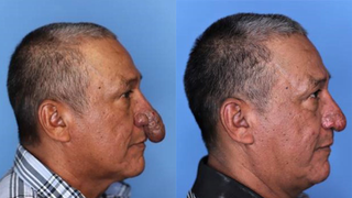 Painter with rare deformity gets new nose for Christmas
