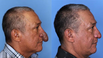 New York painter with rare deformity gets new nose for Christmas