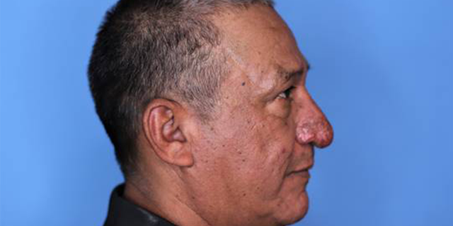 Conrado Estrada after his surgery.