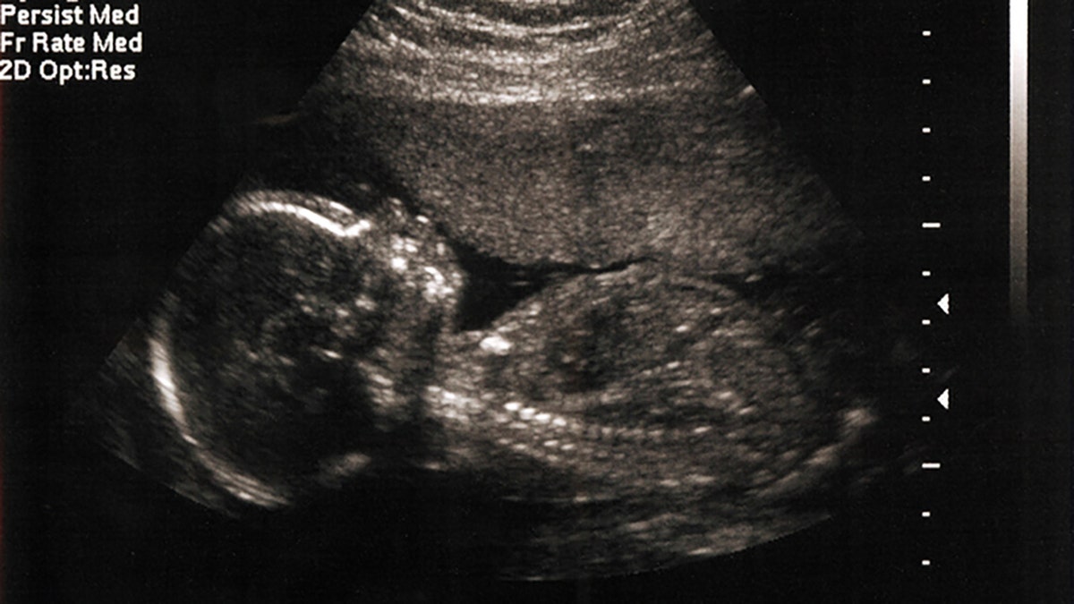 Sonogram image of fetus in womb
