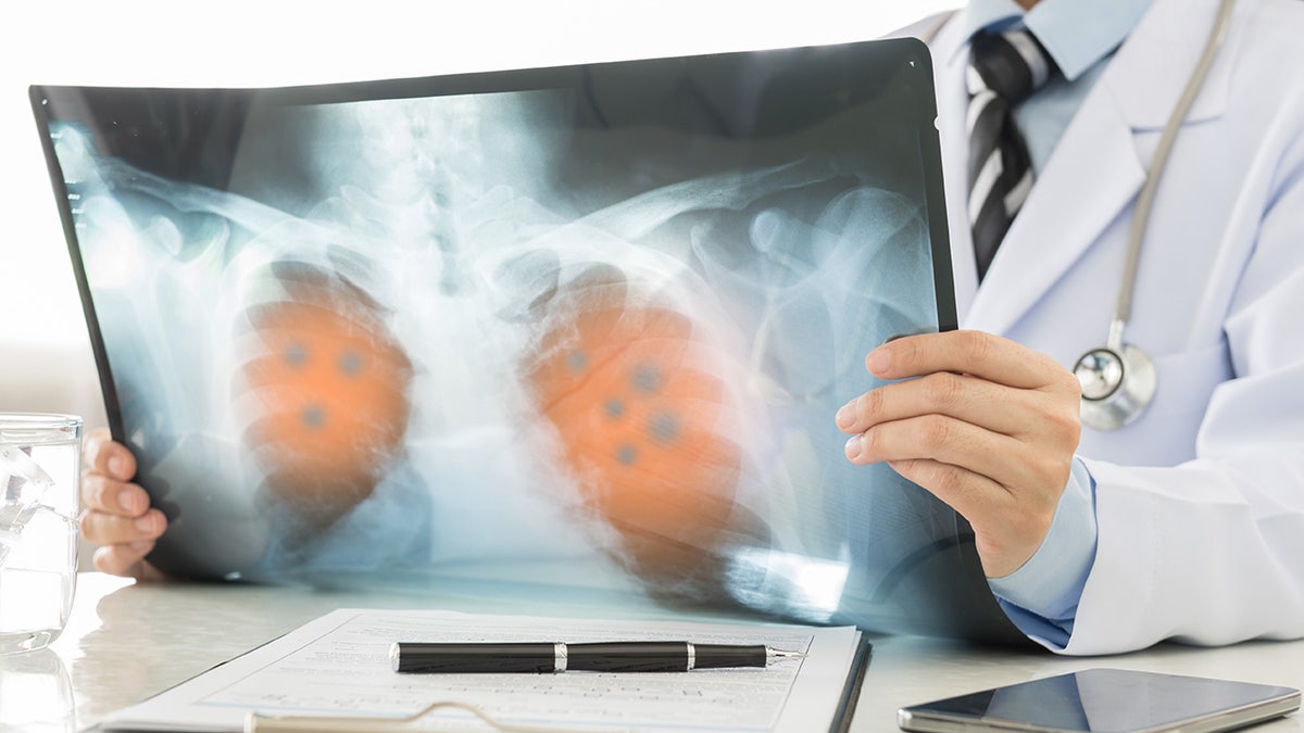 Doctor looking at scans of lung cancer