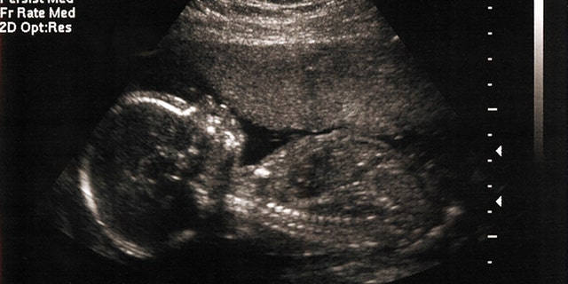 A 5-month fetus in the womb as imaged by sonogram / ultrasound